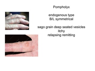 Pompholyx
endogenous type
B/L symmetrical
sago grain deep seated vesicles
itchy
relapsing remitting
 