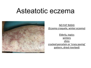 Asteatotic eczema
NO FAT RASH)
(Eczema craquele, winter eczema)
Elderly, topics
winters
shins
cracked porcelain or ‘crazy paving’
pattern, dried riverbed)
 