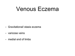 Venous Eczema
• Gravitational/ stasis eczema
• varicose veins
• medial end of limbs
 