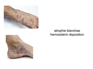 atrophie blanchae
hemosiderin deposition
 
