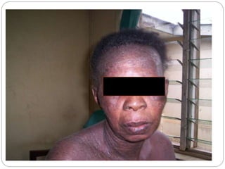 ECZEMA presentation for physiotherapy ppt