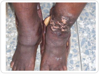 ECZEMA presentation for physiotherapy ppt