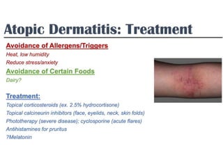 Clinical Pharmacotherapy of Eczema disease.pptx