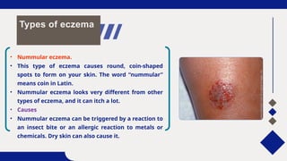 Coin Rash Overview about Eczema and Treatment.pptx