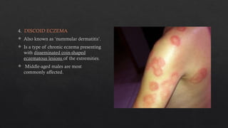 skin disease Eczema pharmacotherapeutics | PPTX