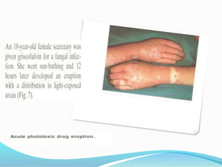 Sphere Excema Eczema basic principles | PPTX