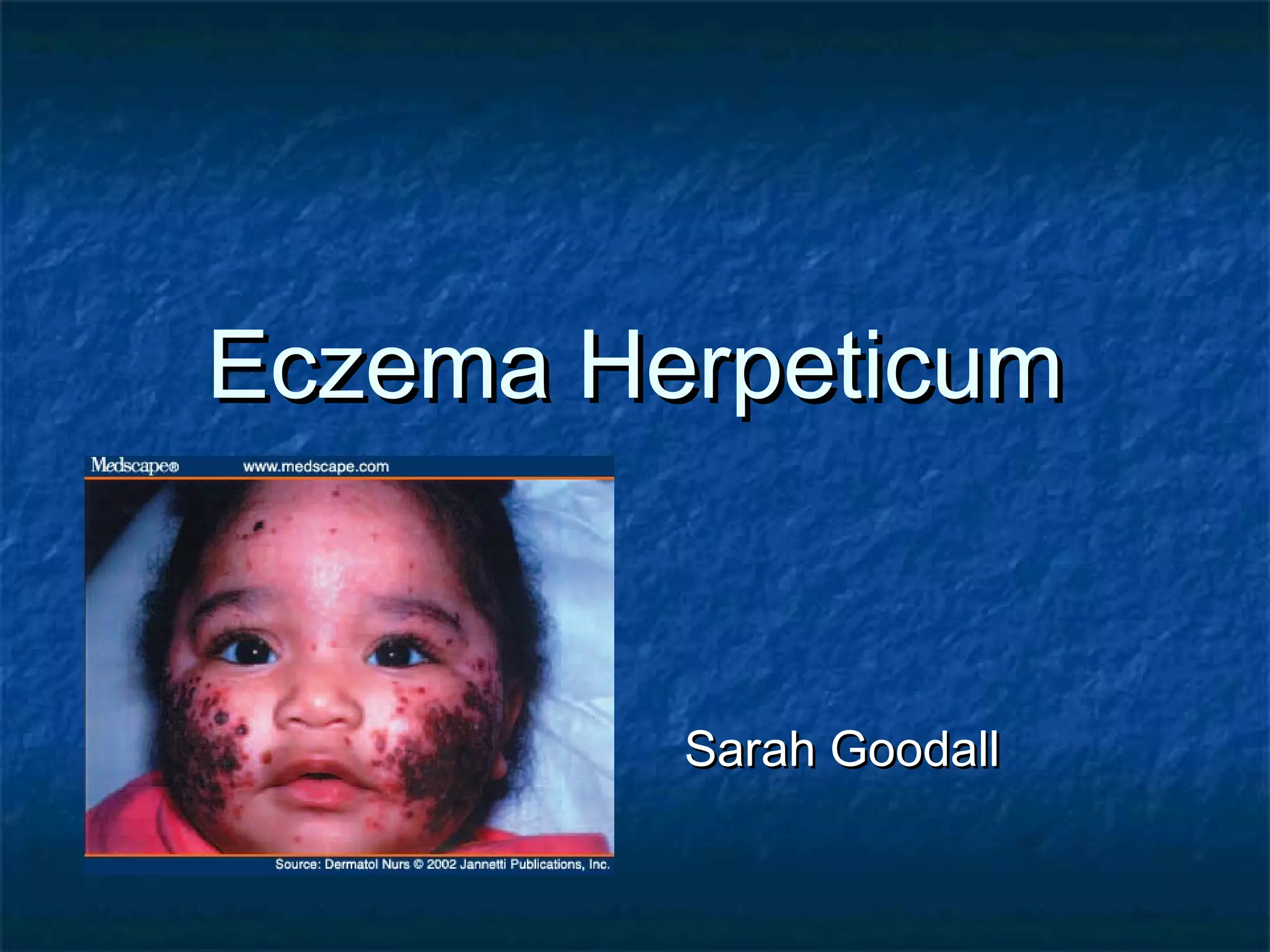 Eczema Herpeticum PPT