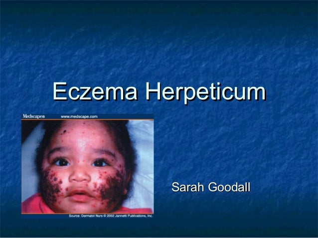 Eczema Herpeticum Eczema Herpeticum