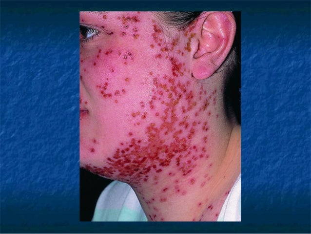 Eczema Herpeticum Eczema Herpeticum