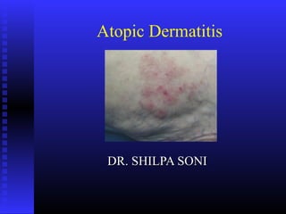 Atopic Dermatitis
DR. SHILPA SONIDR. SHILPA SONI
 
