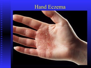 Hand Eczema
 
