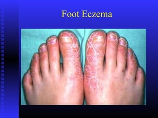 Foot Eczema
 