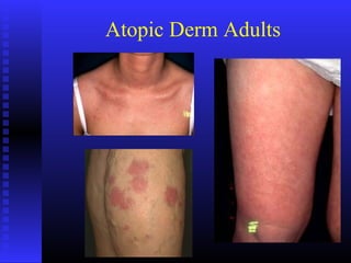 Atopic Derm Adults
 