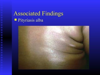 Associated Findings
 Pityriasis albaPityriasis alba
 