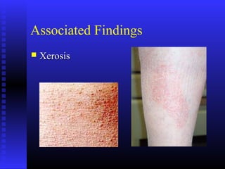 Associated Findings
 XerosisXerosis
 
