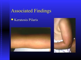 Associated Findings
 Keratosis PilarisKeratosis Pilaris
 