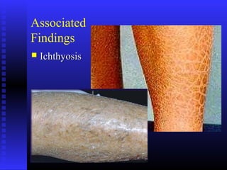 Associated
Findings
 IchthyosisIchthyosis
 