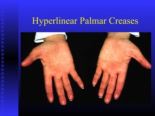 Hyperlinear Palmar Creases
 