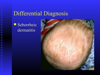 Differential Diagnosis
 SeborrheicSeborrheic
dermatitisdermatitis
 