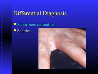 Differential Diagnosis
 Seborrheic dermatitisSeborrheic dermatitis
 ScabiesScabies
 
