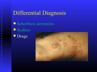 Differential Diagnosis
 Seborrheic dermatitisSeborrheic dermatitis
 ScabiesScabies
 DrugsDrugs
 