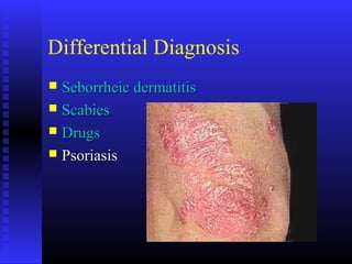 Differential Diagnosis
 Seborrheic dermatitisSeborrheic dermatitis
 ScabiesScabies
 DrugsDrugs
 PsoriasisPsoriasis
 