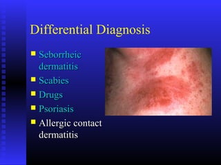 Differential Diagnosis
 SeborrheicSeborrheic
dermatitisdermatitis
 ScabiesScabies
 DrugsDrugs
 PsoriasisPsoriasis
 Allergic contactAllergic contact
dermatitisdermatitis
 