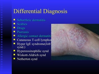 Differential Diagnosis
 Seborrheic dermatitisSeborrheic dermatitis
 ScabiesScabies
 DrugsDrugs
 PsoriasisPsoriasis
 Allergic contact dermatitisAllergic contact dermatitis
 Cutaneous T-cell lymphomaCutaneous T-cell lymphoma
 Hyper IgE syndrome(Job’sHyper IgE syndrome(Job’s
synd.)synd.)
 Hypereosinophilic syndHypereosinophilic synd
 Wiskott-Aldrich syndWiskott-Aldrich synd
 Netherton syndNetherton synd
 