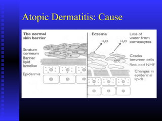 Atopic Dermatitis: Cause
 