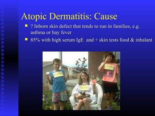 Atopic Dermatitis: Cause
 ? Inborn skin defect that tends to run in families, e.g.? Inborn skin defect that tends to run in families, e.g.
asthma or hay feverasthma or hay fever
 85% with high serum IgE and + skin tests food & inhalant85% with high serum IgE and + skin tests food & inhalant
 
