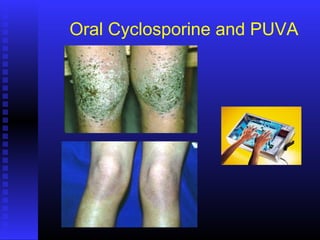 Oral Cyclosporine and PUVA
 
