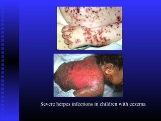 Severe herpes infections in children with eczema
 
