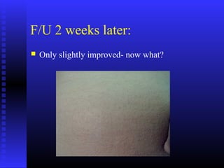 F/U 2 weeks later:
 Only slightly improved- now what?
 