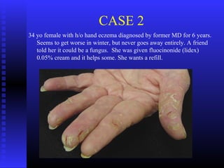 CASE 2
34 yo female with h/o hand eczema diagnosed by former MD for 6 years.
Seems to get worse in winter, but never goes away entirely. A friend
told her it could be a fungus. She was given fluocinonide (lidex)
0.05% cream and it helps some. She wants a refill.
 