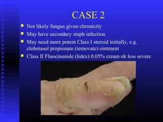 CASE 2
 Not likely fungus given chronicity
 May have secondary staph infection
 May need more potent Class I steroid initially, e.g.
clobetasol propionate (temovate) ointment
 Class II Fluocinonide (lidex) 0.05% cream ok less severe
 