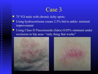 Case 3
 75 YO male with chronic itchy spots-
 Using hydrocortisone cream 2.5% bid to ankle- minimal
improvement
 Using Class II Fluocinonide (lidex) 0.05% ointment under
occlusion to hip area- “only thing that works”
 