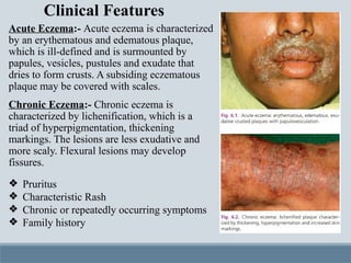ECZEMA 3rd year notes with images .pptx