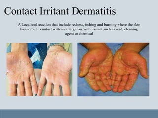Localized Redeness ECZEMA 3rd year notes with images .pptx