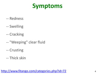 Symptoms
   -- Redness
   -- Swelling
   -- Cracking
   -- "Weeping" clear fluid
   -- Crusting
   -- Thick skin


http://www.fitango.com/categories.php?id=72   4
 