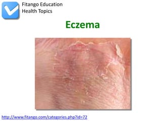 Fitango Education
          Health Topics

                                Eczema




http://www.fitango.com/categories.php?id=72
 