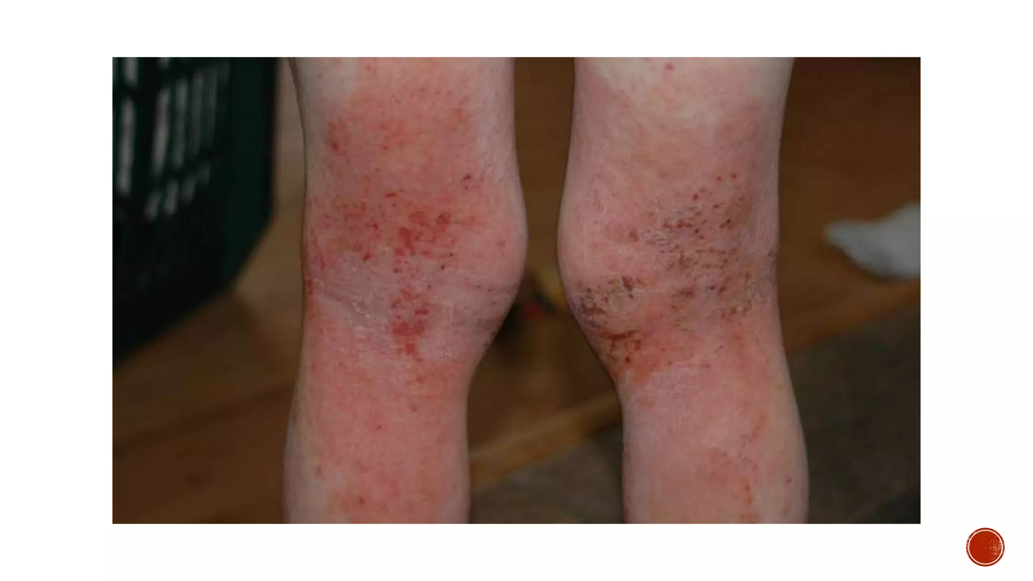 Eczema (The Itch that rashes) | PPT
