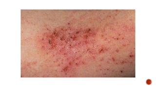 Eczema (The Itch that rashes) | PPTX