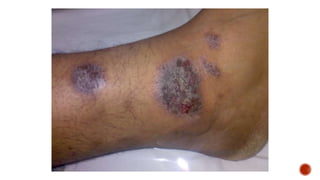 Eczema (The Itch that rashes) | PPTX