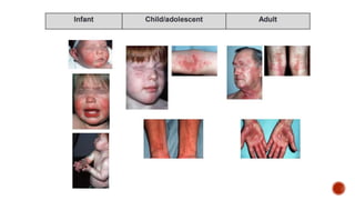 Eczema (The Itch that rashes) | PPTX