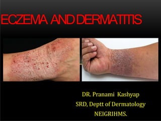 DR. Pranami Kashyap
SRD, Deptt of Dermatology
NEIGRIHMS.
ECZEMA ANDDERMATITIS
 