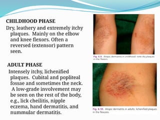 Flexor Rash Comprehensive Overview of Eczema and Dermatitis: Types, Diagnosis, and ...