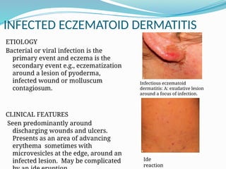 Comprehensive Overview of Eczema and Dermatitis: Types, Diagnosis, and ...