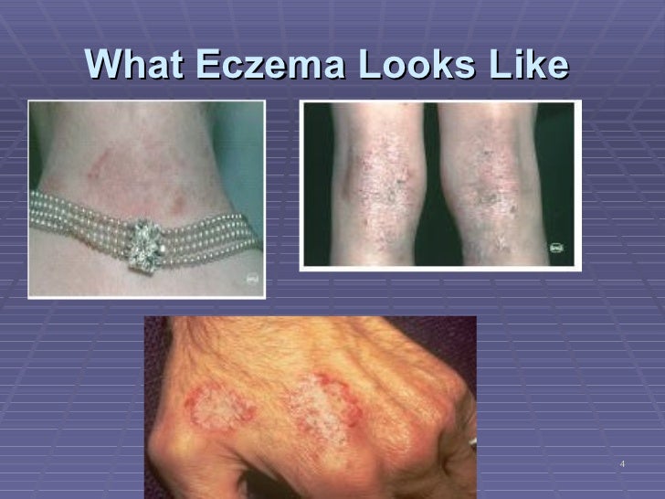 Eczema And Ginseng