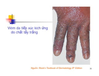 Viêm da tiếp xúc kích ứng
do chất tẩy trắng
35Nguồn: Rook’s Textbook of Dermatology 8th Edition
 