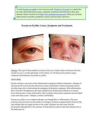 To treat Eczema on eyelids is not a very easy task. Psoriasis vs Eczema is a website that
       provides information about causes, symptoms, treatments and much more about skin
       diseases. Please visit this site at http://www.psoriasisvseczema.com where you can learn
       about eczema on eyelids, pompholyx eczema, psoriasis penis and more…



                Eczema on Eyelids: Causes, Symptoms and Treatments




Abstract: This type of skin condition, eczema on the eyes is hard to deal with because the skin
around our eyes is so thin and fragile. In this article, we will discuss the common causes,
symptoms and treatments of eczema on eyelids.

Article Body:

Eyelid swelling or any form of skin inflammation is properly labeled as dermatitis. Allergies of
any type by the way are not the only known causes of dermatitis. Irritants and genetic factors
also play huge roles in determining the emergence of dermatitis symptoms. Skin inflammation
that is limited to the uppermost skin layer (epidermis) is distinctively referred to as eczema.
Given that eczema is a type of dermatitis, then it explains why eczema symptoms are also linked
to the same three causes - allergies, irritants, and heredity.

Eczema on eyelid is not an infection though, even though there is inflammation. The most
common cause of eczema on the eyelids is an allergen. Contrary to popular belief, food isn't the
only allergen that can trigger eczema on the eyelid. Allergens can also come from the
environment although this is less common. It truly relies on a person and what substance his or
her body reacts to.
 